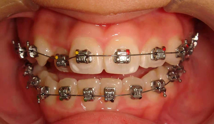 self ligating bracket