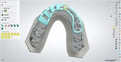 Brackets Indirect Bonding